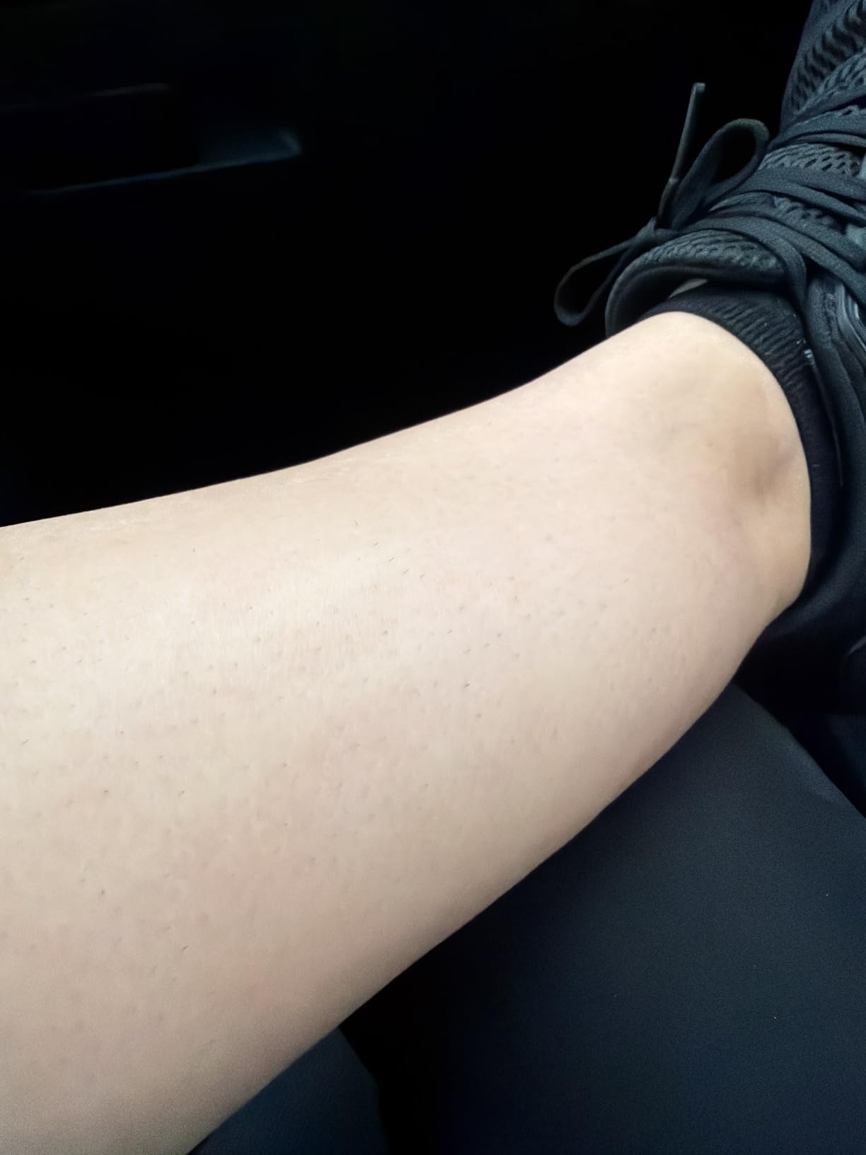 Philips Lumea IPL — Salon-Like Laser Hair Removal for Women, Permanent Hair Reduction Device At Home for Face & Body — Safe & Painless for Face, Bikini, Body, 5 Settings & Skin Sensors, BRI984/03 customer photo 1